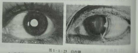 初級(jí)驗(yàn)光師培訓(xùn)知識(shí)點(diǎn)：影響視覺(jué)的原因分析