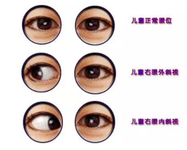 驗光師培訓(xùn)測試斜視的一些小方法