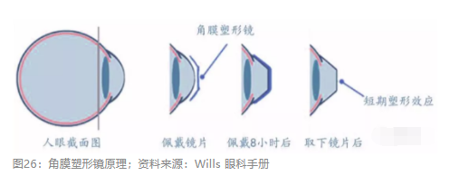 2018眼科行業(yè)報告：市場有較大增長，消費升級推動角塑快速成長