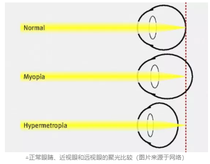 探討青少年近視與電子屏幕關(guān)系，近視關(guān)聯(lián)強(qiáng)因素詳細(xì)分析