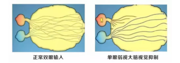 眼視光科普成人的弱斜視會影響正常生活嗎？