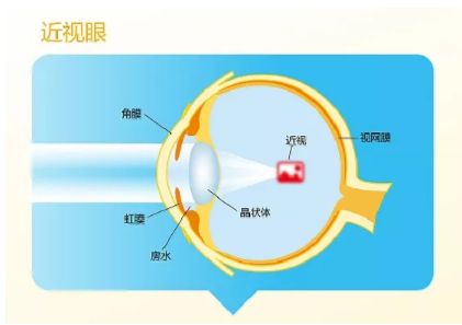 深圳驗(yàn)光師培訓(xùn)近視一定會(huì)遺傳嗎？