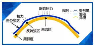 驗(yàn)光師講述孩子戴了角膜塑形鏡近視度數(shù)還會(huì)漲嗎？