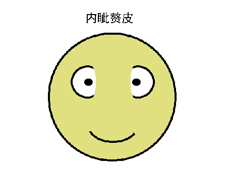驗(yàn)光配鏡中遇到的20多種斜視眼位特點(diǎn)