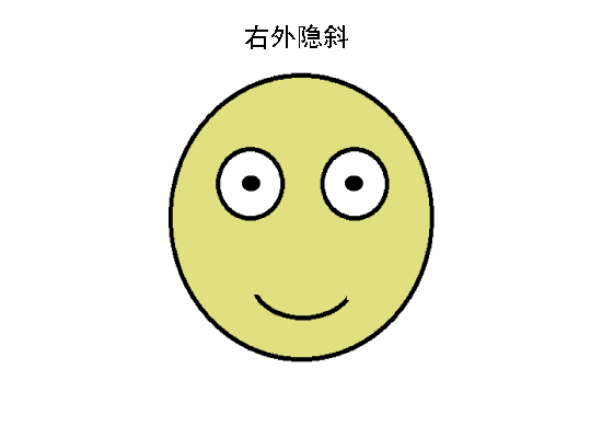 驗(yàn)光配鏡中遇到的20多種斜視眼位特點(diǎn)