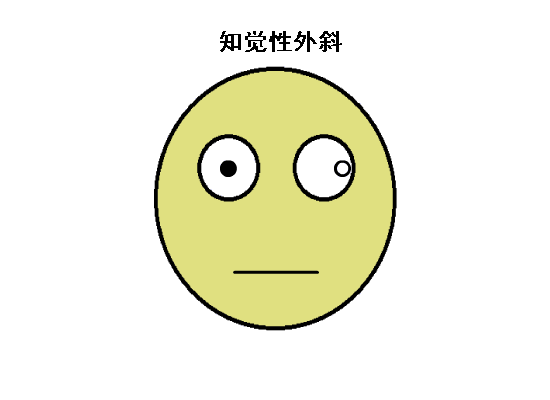 驗(yàn)光配鏡中遇到的20多種斜視眼位特點(diǎn)