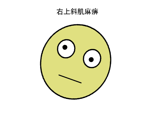 驗(yàn)光配鏡中遇到的20多種斜視眼位特點(diǎn)