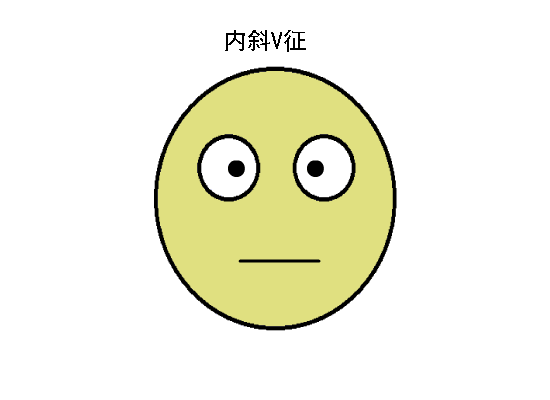 驗(yàn)光配鏡中遇到的20多種斜視眼位特點(diǎn)