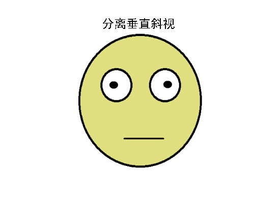 驗(yàn)光配鏡中遇到的20多種斜視眼位特點(diǎn)