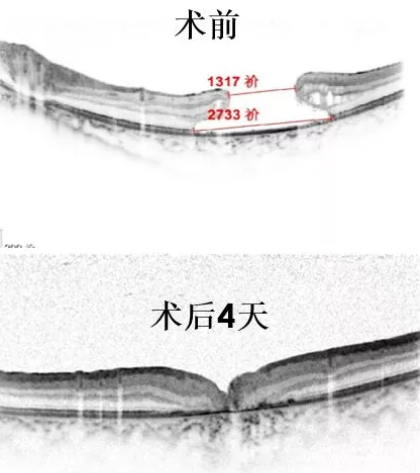 11歲患兒因激光筆損害視網(wǎng)膜造成罕見巨大黃斑裂孔，溫醫(yī)大眼視光成功治愈